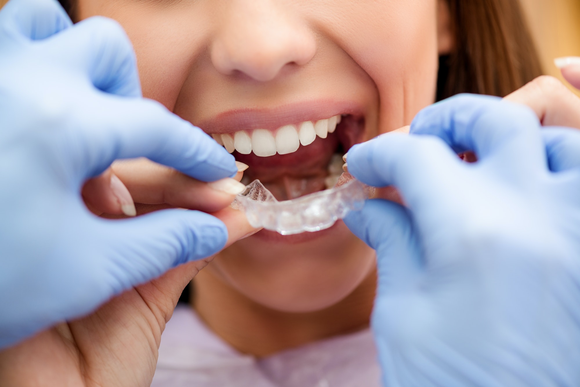 When Should You Consider Braces?